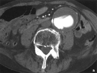 Bolile aortice - anevrismul de aorta